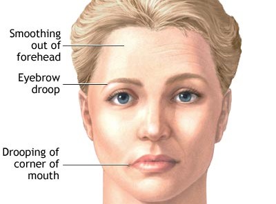 myasthenia-gravis